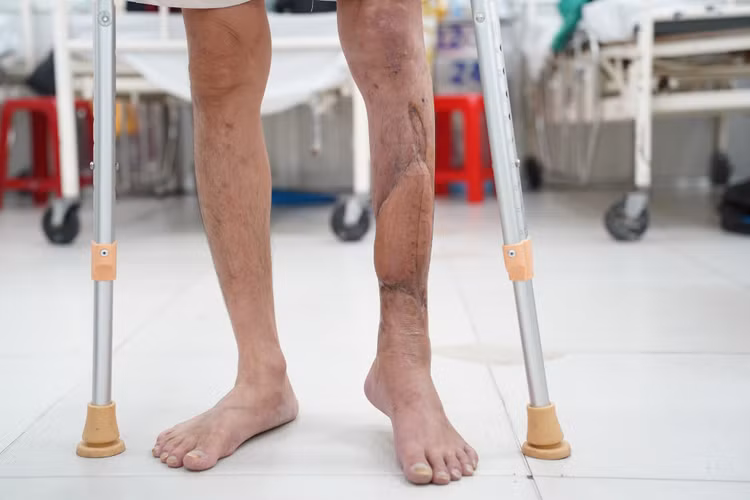 Bệnh nhân tập đi lại - ảnh BVCC