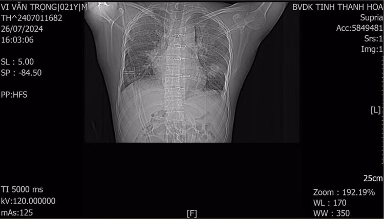 Hình ảnh phim chụp CLVT phổi của bệnh nhân sau 1 tuần phẫu thuật