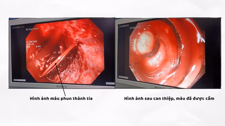 Kiểm tra lại sau thủ thuật thấy điểm vỡ giãn đã cầm máu