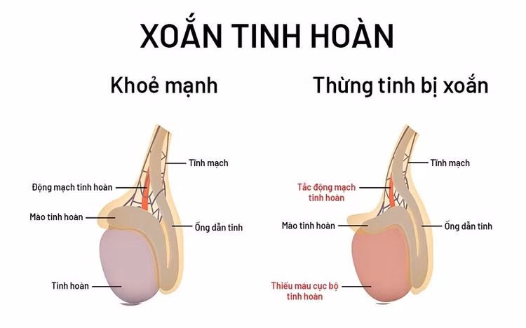 Xoắn tinh hoàn là tình trạng cấp cứu cần đến viện gấp - Ảnh minh họa