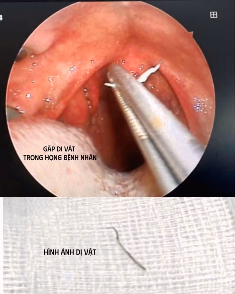 Dị vật trong amidan của bệnh nhân được các bác sĩ gắp ra - Ảnh BVCC Dị vật trong amidan của bệnh nhân được các bác sĩ gắp ra - Ảnh BVCC