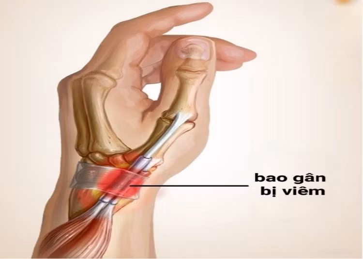 Bác sĩ chỉ rõ lý do khó vận động cổ tay do viêm gân ảnh 1