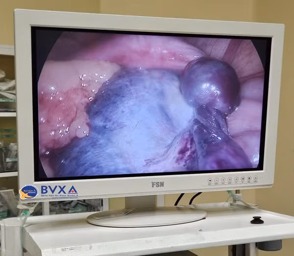 U buồng trứng kích thước lớn xoắn vặn - Ảnh BVCC U buồng trứng kích thước lớn xoắn vặn - Ảnh BVCC