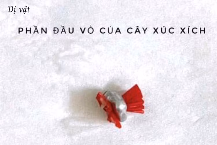Dị vật được lấy ra thành công - Ảnh BVCC Dị vật được lấy ra thành công - Ảnh BVCC