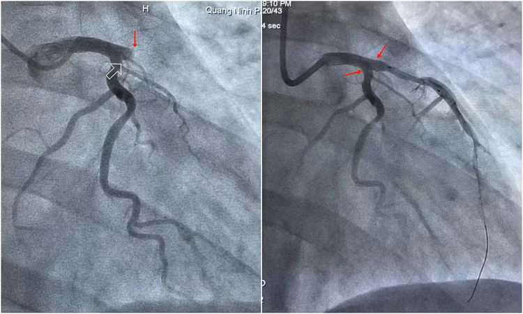 Hình ảnh mạch vành bị tắc hoàn toàn được đặt stent tái thông thành công. Hình ảnh mạch vành bị tắc hoàn toàn được đặt stent tái thông thành công.