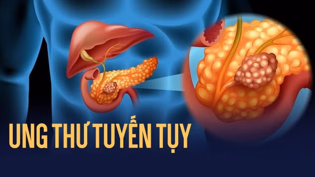Cách phát hiện sớm ung thư tụy sâu trong ổ bụng, ác tính, tử vong cao ảnh 1