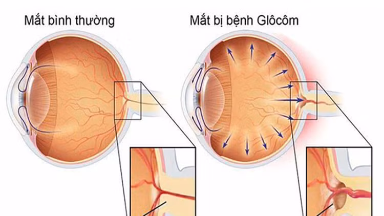Biểu hiện mắt bị glocom - Ảnh minh họa Biểu hiện mắt bị glocom - Ảnh minh họa