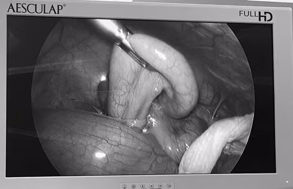 Viêm ruột thừa cấp trên hình ảnh nội soi - Ảnh BVCC