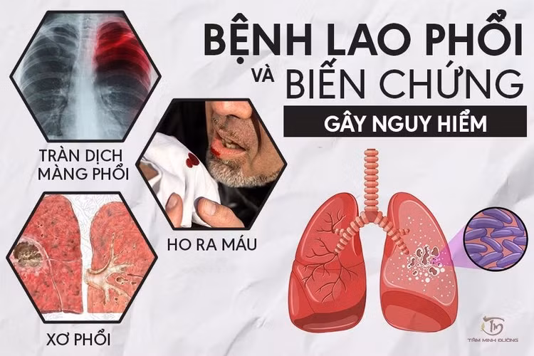 Phục hồi sau điều trị lao phổi tránh di chứng ảnh 1 Phục hồi sau điều trị lao phổi tránh di chứng ảnh 1