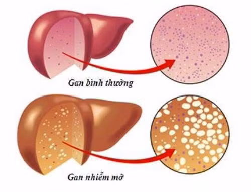 Biểu hiện của gan nhiễm mỡ - Ảnh minh họa Biểu hiện của gan nhiễm mỡ - Ảnh minh họa