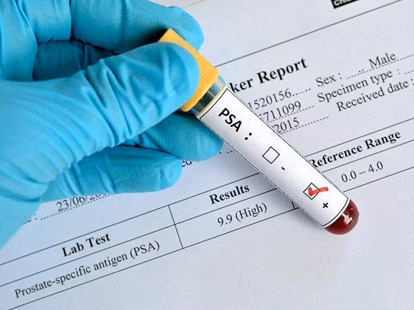 Xét nghiệm PSA kháng nguyên đặc hiệu tiền liệt tuyến