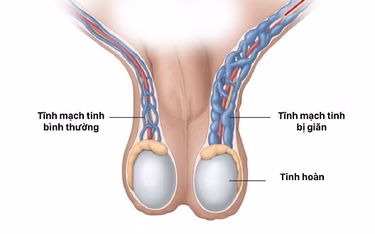 Giãn tĩnh mạch thừng tinh - Ảnh minh họa Giãn tĩnh mạch thừng tinh - Ảnh minh họa