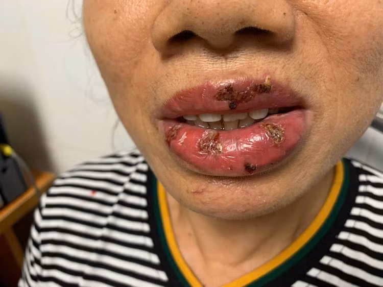 Người bệnh bị viêm da nhiễm trùng do xăm môi