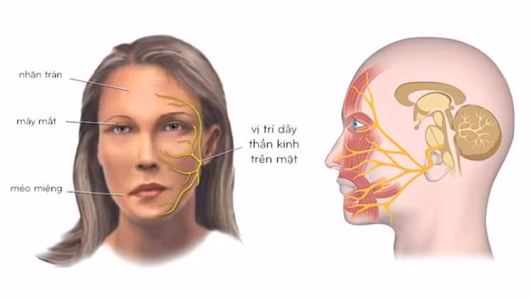 Nhiễm lạnh dễ liệt dây thần kinh VII - Ảnh minh hoạ