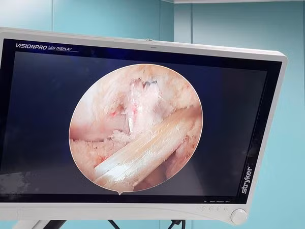 Hình ảnh tổn thương dây chằng trong nội soi - Ảnh BVCC
