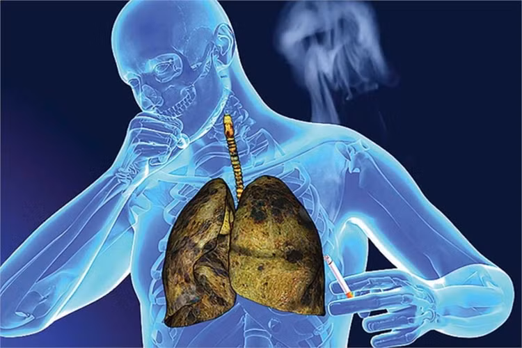 Hút thuốc lá gây ung thư phổi Hút thuốc lá gây ung thư phổi