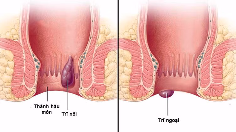 Bác sĩ chỉ rõ “kẻ thù giấu mặt” gây trĩ, hiểu đúng phòng ngừa hiệu quả - Ảnh BSCC Bác sĩ chỉ rõ “kẻ thù giấu mặt” gây trĩ, hiểu đúng phòng ngừa hiệu quả - Ảnh BSCC