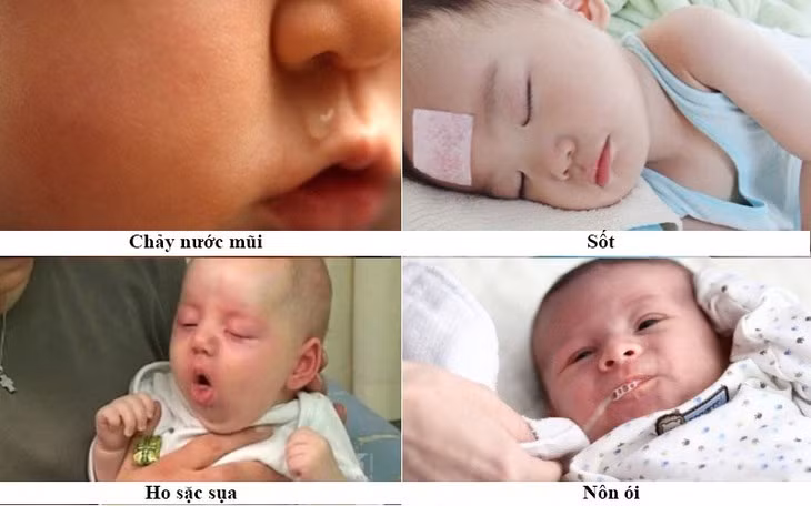 Bệnh ho gà có biểu hiện lâm sàng đặc trưng bởi những triệu chứng như ho, hắt hơi, sổ mũi, sốt nhẹ...
