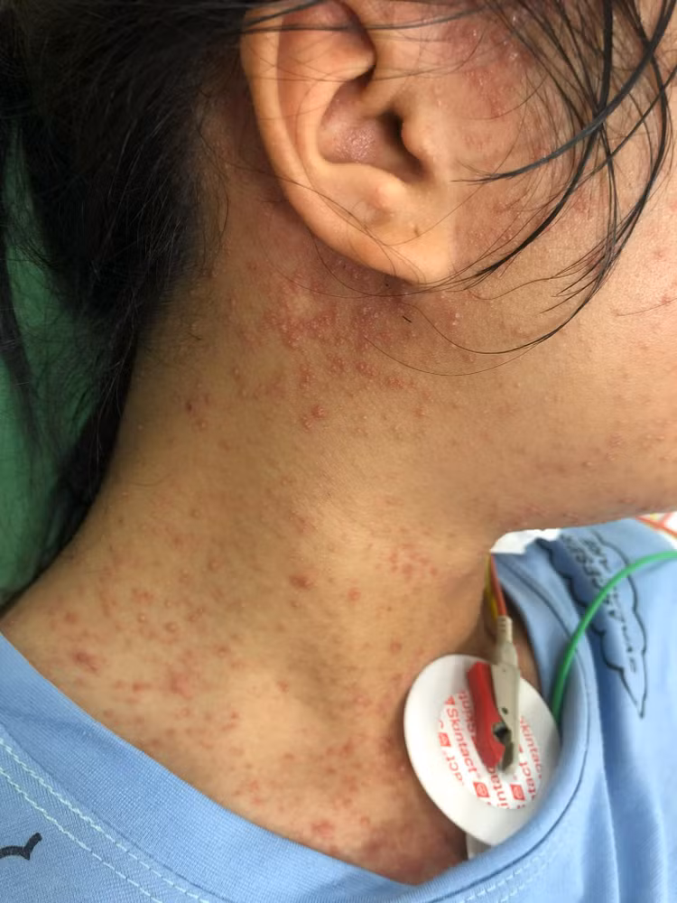 Tổn thương thủy đậu trên cơ thể bệnh nhân - ảnh BVCC Tổn thương thủy đậu trên cơ thể bệnh nhân - ảnh BVCC