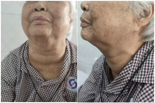 Hình ảnh người bệnh trước phẫu thuật, bướu cổ to