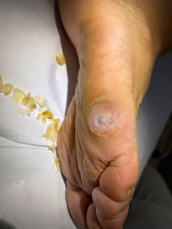 Bác sĩ mách cách chăm sóc và điều trị chai chân ảnh 2
