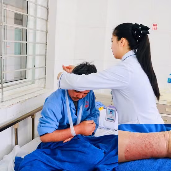 Đắp lá thuốc để giảm đau người đàn ông 51 tuổi bị sưng nề cánh tay.
