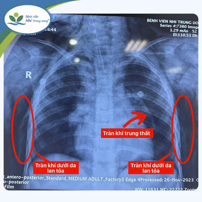 Hình ảnh phim chụp X-quang cho thấy trẻ bị tràn khí màng phổi 2 bên, tràn khí trung thất