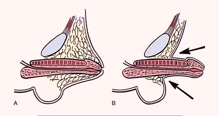 Bác sĩ mách cách phát hiện và điều trị vùi dương vật bẩm sinh ở trẻ ảnh 1 Bác sĩ mách cách phát hiện và điều trị vùi dương vật bẩm sinh ở trẻ ảnh 1