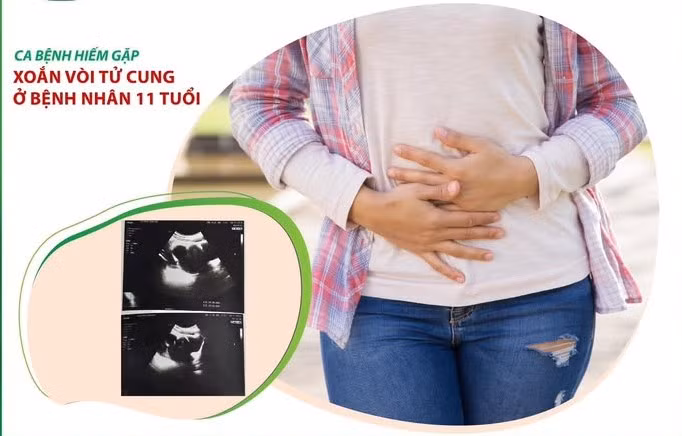 Hiếm gặp trường hợp xoắn vòi tử cung ở bệnh nhân 11 tuổi - Ảnh minh hoạ Hiếm gặp trường hợp xoắn vòi tử cung ở bệnh nhân 11 tuổi - Ảnh minh hoạ