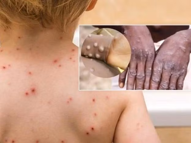 Mầm bệnh đậu mùa khỉ đã xâm nhập trong cộng đồng - Ảnh minh họa