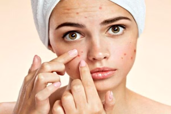 Nổi mụn trên da là một dấu hiệu của rối loạn nội tiết