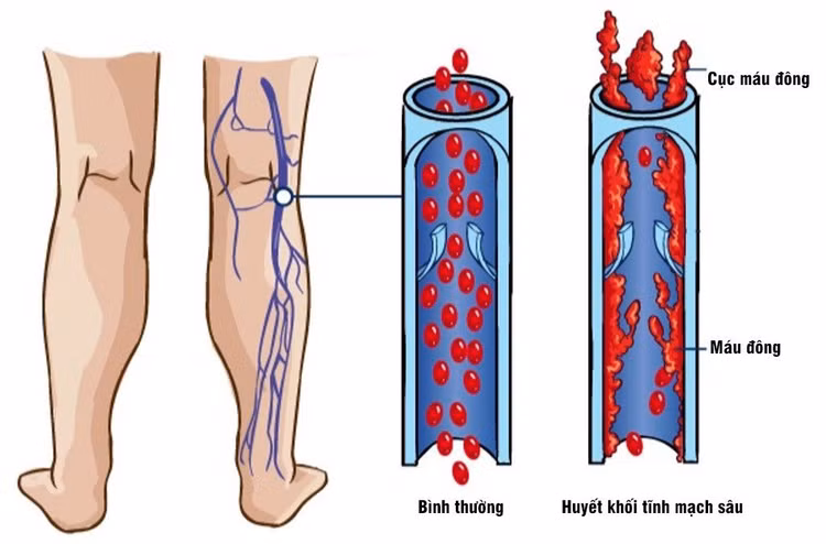 Hình ảnh minh họa huyết khối tĩnh mạch sâu
