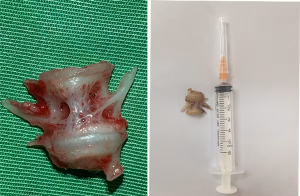 Gắp mảnh xương cá lớn cắm sâu trong thực quản người bệnh ảnh 1