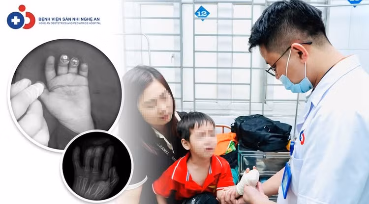 Nghịch dao, trẻ bị đứt lìa nhiều đốt ngón tay - Ảnh BVCC Nghịch dao, trẻ bị đứt lìa nhiều đốt ngón tay - Ảnh BVCC