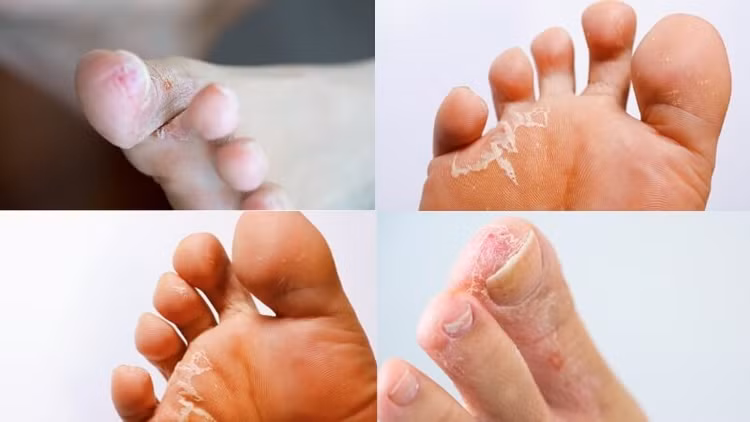 Các bệnh về da dễ gặp mùa mưa bão - Ảnh minh họa