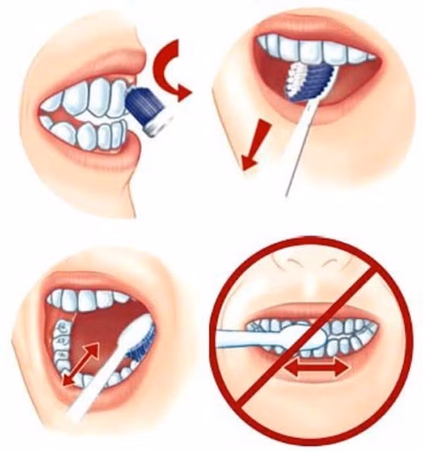 Chuyên gia chỉ rõ những sai lầm khi đánh răng làm tăng sâu răng, viêm nướu ảnh 1 Chuyên gia chỉ rõ những sai lầm khi đánh răng làm tăng sâu răng, viêm nướu ảnh 1