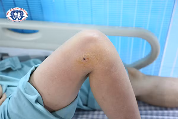 Hình ảnh vết mổ trên đùi phải của người bệnh