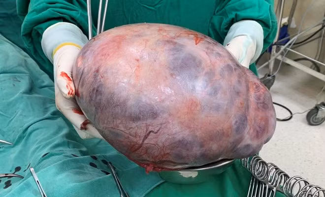 Khối u buồng trứng được lấy ra từ bé gái 15 tuổi Khối u buồng trứng được lấy ra từ bé gái 15 tuổi