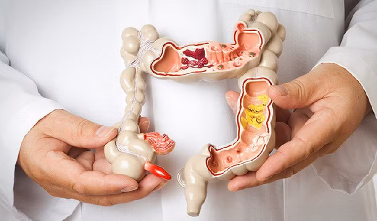 Ung thư đường tiêu hóa - Ảnh minh họa