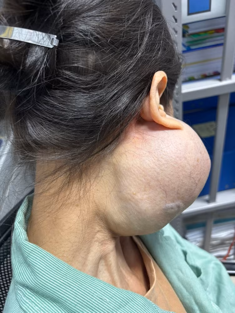 Suýt mất mạng vì 14 năm không điều trị u “khổng lồ” trên mặt - Ảnh BVCC