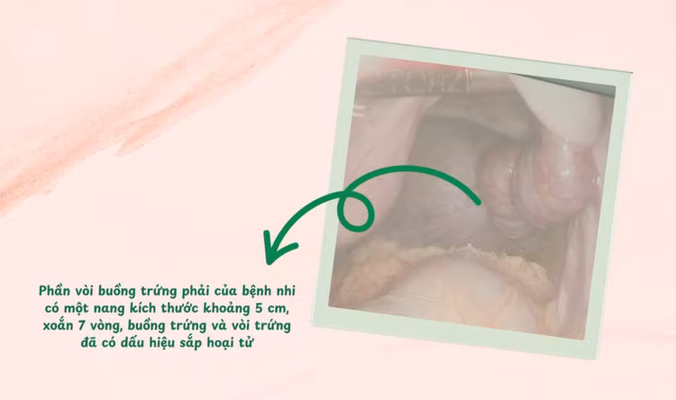 Vòi trứng xoắn - Ảnh BVCC Vòi trứng xoắn - Ảnh BVCC