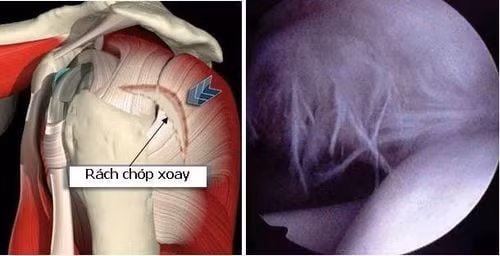 Chóp xoay có thể bị rách ở bất cứ vị trí nào, nhưng thường nhất là rách cơ trên gai Chóp xoay có thể bị rách ở bất cứ vị trí nào, nhưng thường nhất là rách cơ trên gai