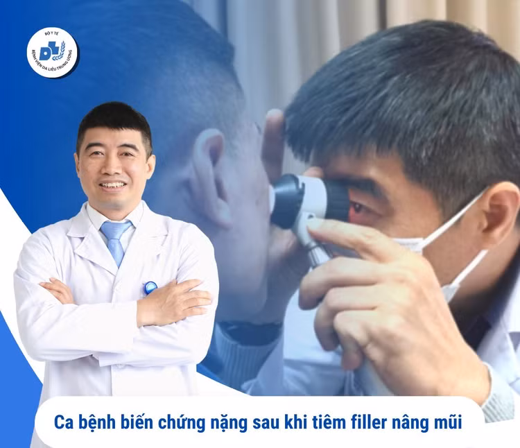 Tiêm filler nâng mũi, quý ông 36 tuổi phải cấp cứu vì hoại tử ảnh 1 Tiêm filler nâng mũi, quý ông 36 tuổi phải cấp cứu vì hoại tử ảnh 1