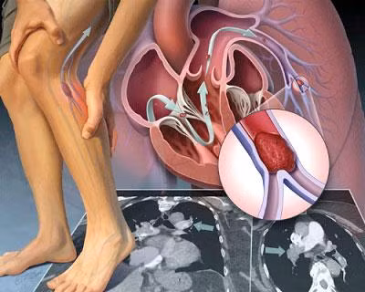 Biểu hiện của viêm tắc động mạch chi - Ảnh minh họa