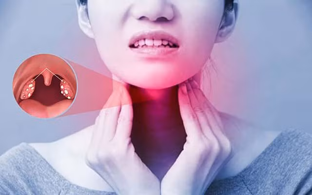 Viêm họng mãn tính có tiến triển thành ung thư? - Ảnh minh hoạ Viêm họng mãn tính có tiến triển thành ung thư? - Ảnh minh hoạ