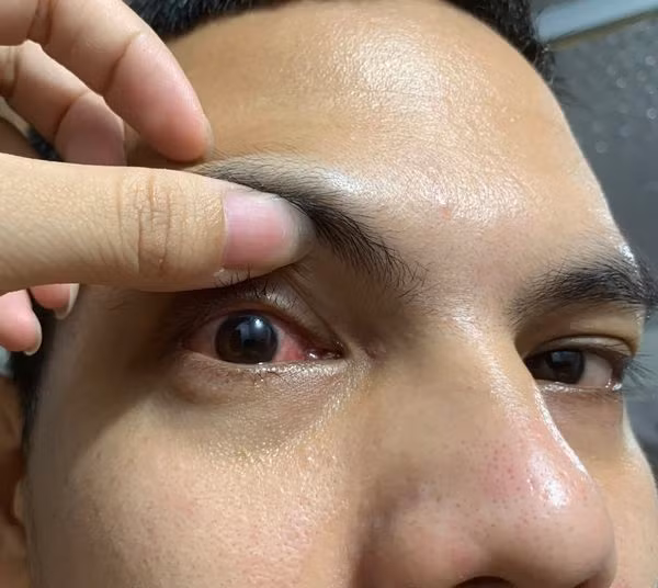 Đau mắt đỏ Đau mắt đỏ