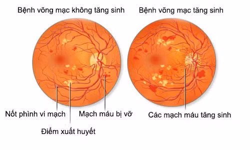 Bong võng mạc đái tháo đường Bong võng mạc đái tháo đường