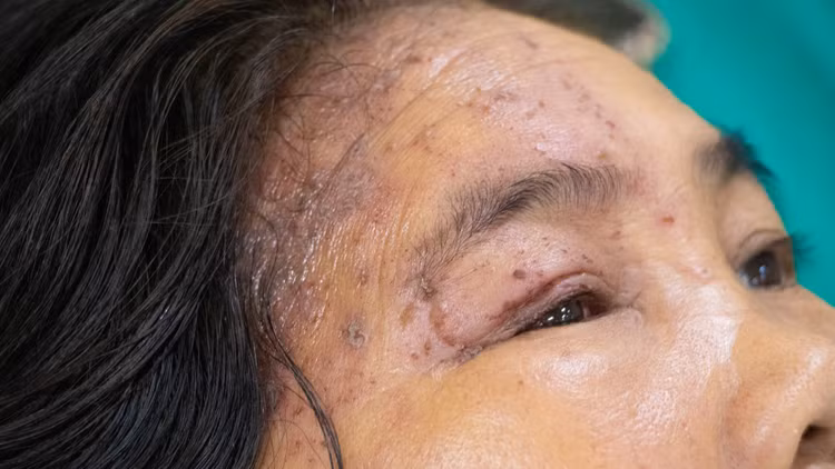 Bệnh nhân bị bội nhiễm nặng do bôi dầu trị zona Bệnh nhân bị bội nhiễm nặng do bôi dầu trị zona