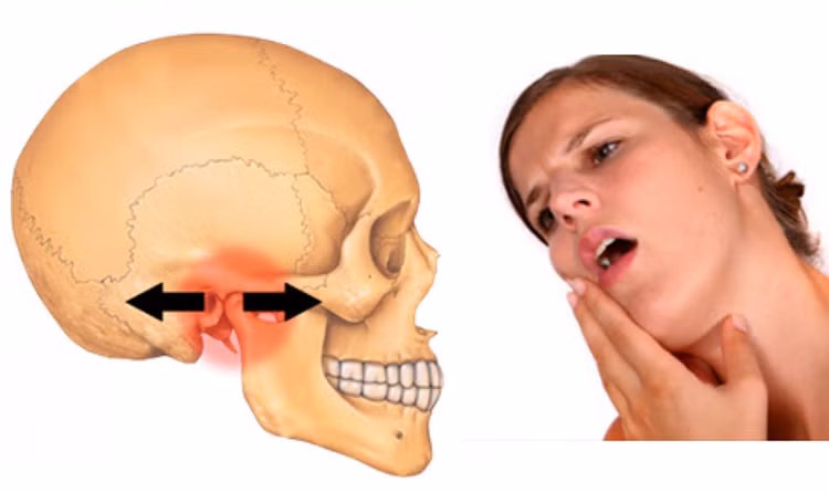 Viêm khớp thái dương hàm - Ảnh minh họa Viêm khớp thái dương hàm - Ảnh minh họa
