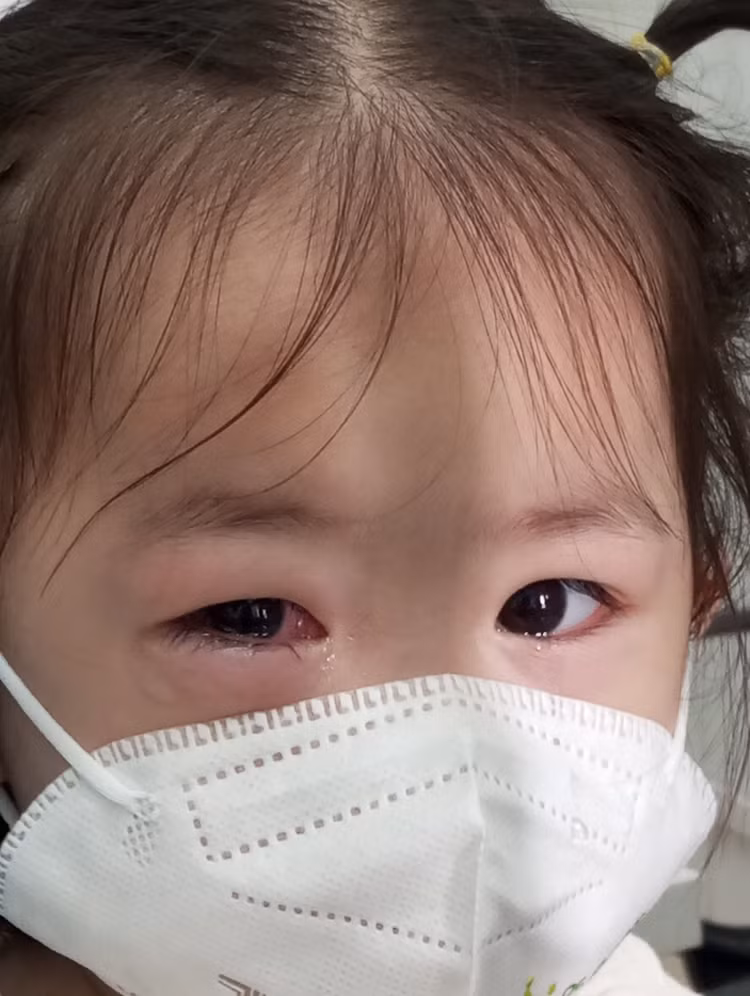Đau mắt đỏ đang bùng phát ở nhiều tình thành Đau mắt đỏ đang bùng phát ở nhiều tình thành